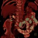 Nephrolithiasis, kidney stones, hydronephrosis, pyelonephritis, chronic: CT - Computed tomography